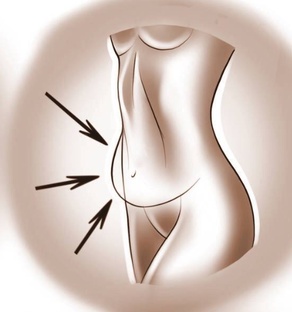 Пластика живота 