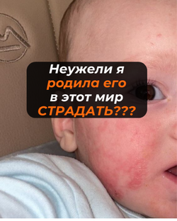 Атопический дерматит