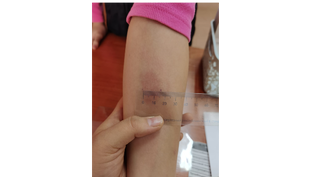 Профилактика туберкулеза