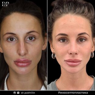 Ринопластика | До-После