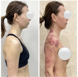 Омоложение лица