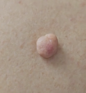 Удаление новообразований кожи