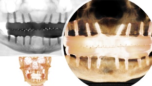 Протезирование