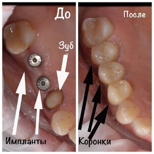 Имплантация