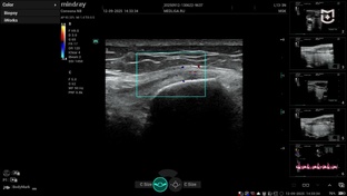 УЗИ суставов