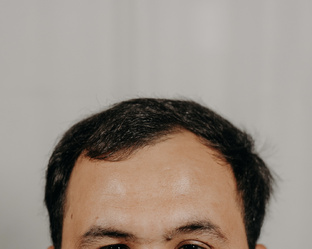 Пересадка волос | Мужская версия