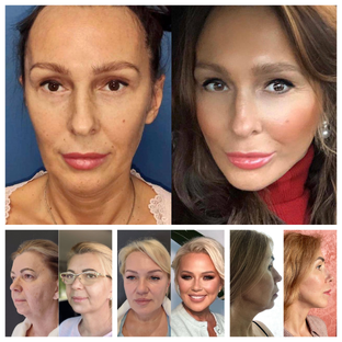 Смас-подтяжка лица