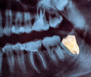 Зубы мудрости