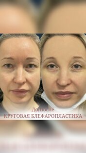 Блефаропластика 