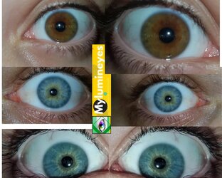 laser eye color change before and after