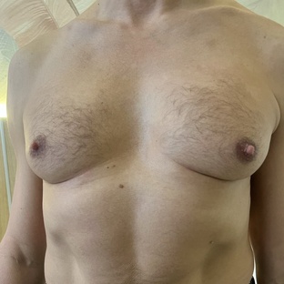 Лечение гинекомастии