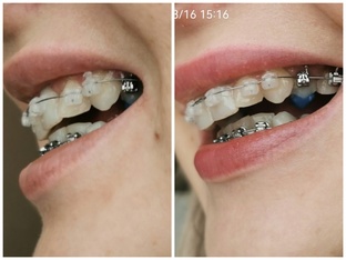 Зубы и их лечение. Моя история