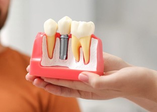 Имплантация зубов: руководство к новой улыбке!