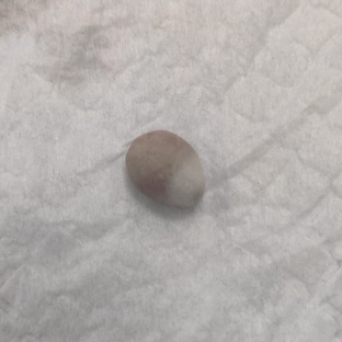 Мочекаменная болезнь