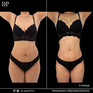 Абдоминопластика | До-После
