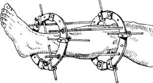 Про перелом ноги