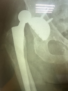 КАК ЖИТЬ ПОСЛЕ ОПЕРАЦИИ ПО ПРОТЕЗИРОВАНИЮ ТАЗОБЕДРЕННОГО СУСТАВА 