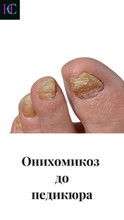 Заболевания ногтей