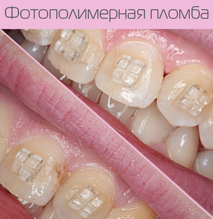 Фотополимерная пломба