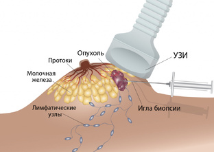 Рак молочной железы