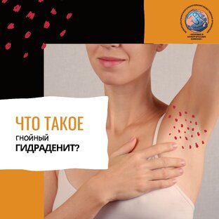 Гнойный гидраденит- жизнь и борьба