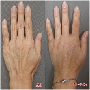 Липофилинг, липосакция и липоскульптура