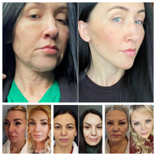 Комплекс ТОТАЛ ФЭЙС. Пластика лица