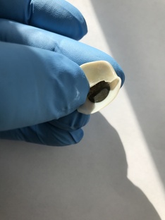 Опасно для здоровья: почему глазной протез нельзя чинить дома 