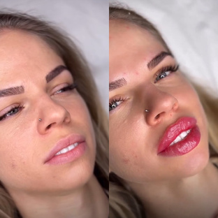 Увеличение губ💋