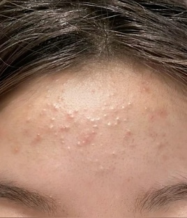 Комедональное акне