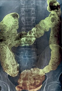 Запор. Важно знать, чтобы победить