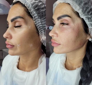 Инъекции лицо/тело