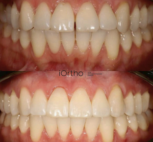 Результаты лечения iOrtho  