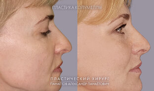Ринопластика