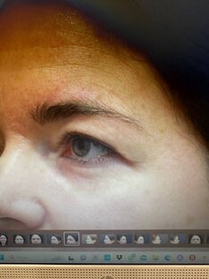 Блефаропластика