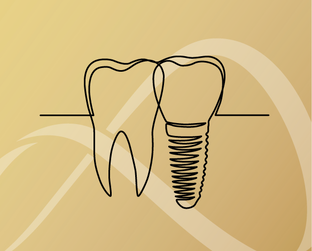 Имплантация зубов
