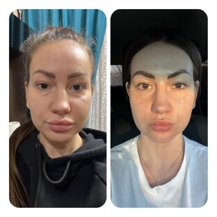 До и после постановки мезонитей в нижнюю треть (промежуточный результат )