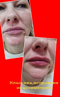 Аугументация губ 