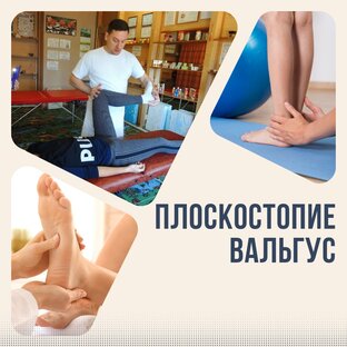 Плоскостопие, вальгус, разная длина ног, травмы ног