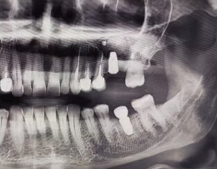 Синус-лифтинг и имплантация 🦷