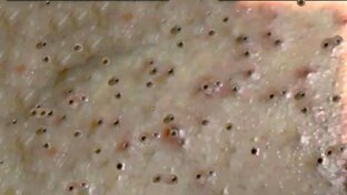 Удаление....Чистка кожи лица и тела от угрей и чёрных точек.....