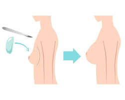 Маммопластика 