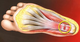 Боль в стопе.