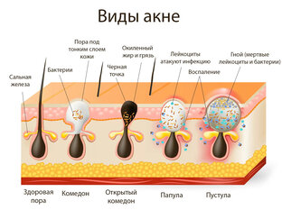Лечение акне и постакне