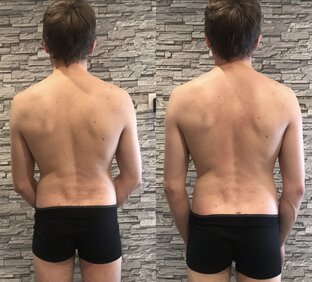 Сколиотическая осанка