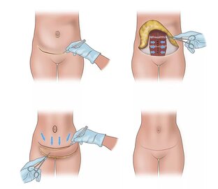 Абдоминопластика 