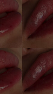 Контурная пластика лица и губ