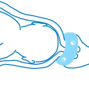 ИЦН (истмико-цервикальная недостаточность)