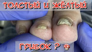 Грибок ногтей / Онихомикоз