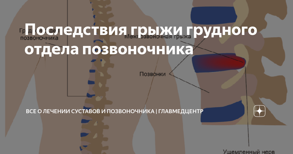 Симптомы грыжи грудного отдела у мужчин Симптомы грыжи грудного отдела у мужчин